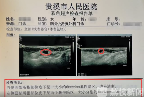 女子为变美花6100元注射“逆龄修复针”   结果却“老了好几岁”