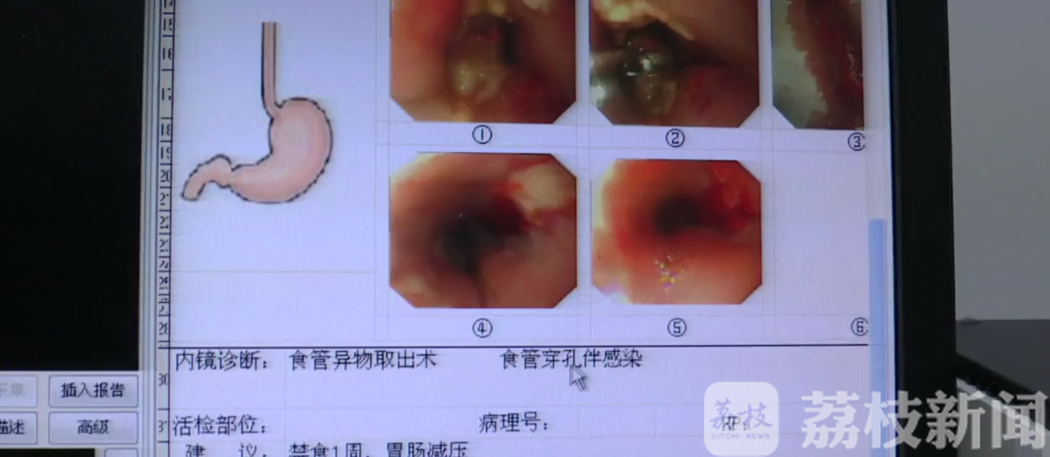 「医生」医生妙手化险为夷 七旬老人误吞枣核