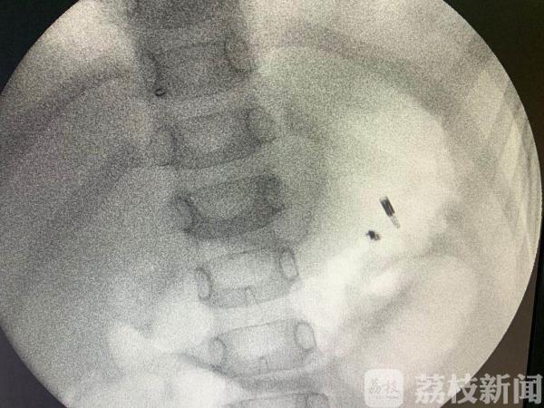 钉子■险些胃穿孔！5岁男孩偷偷吞下数枚钉子