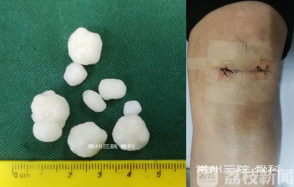 「关节」医生镜下巧捉“关节鼠” 膝盖卡壳频折磨