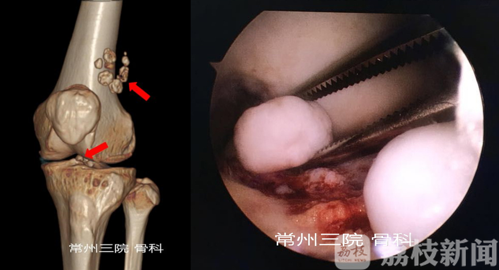 「关节」医生镜下巧捉“关节鼠” 膝盖卡壳频折磨
