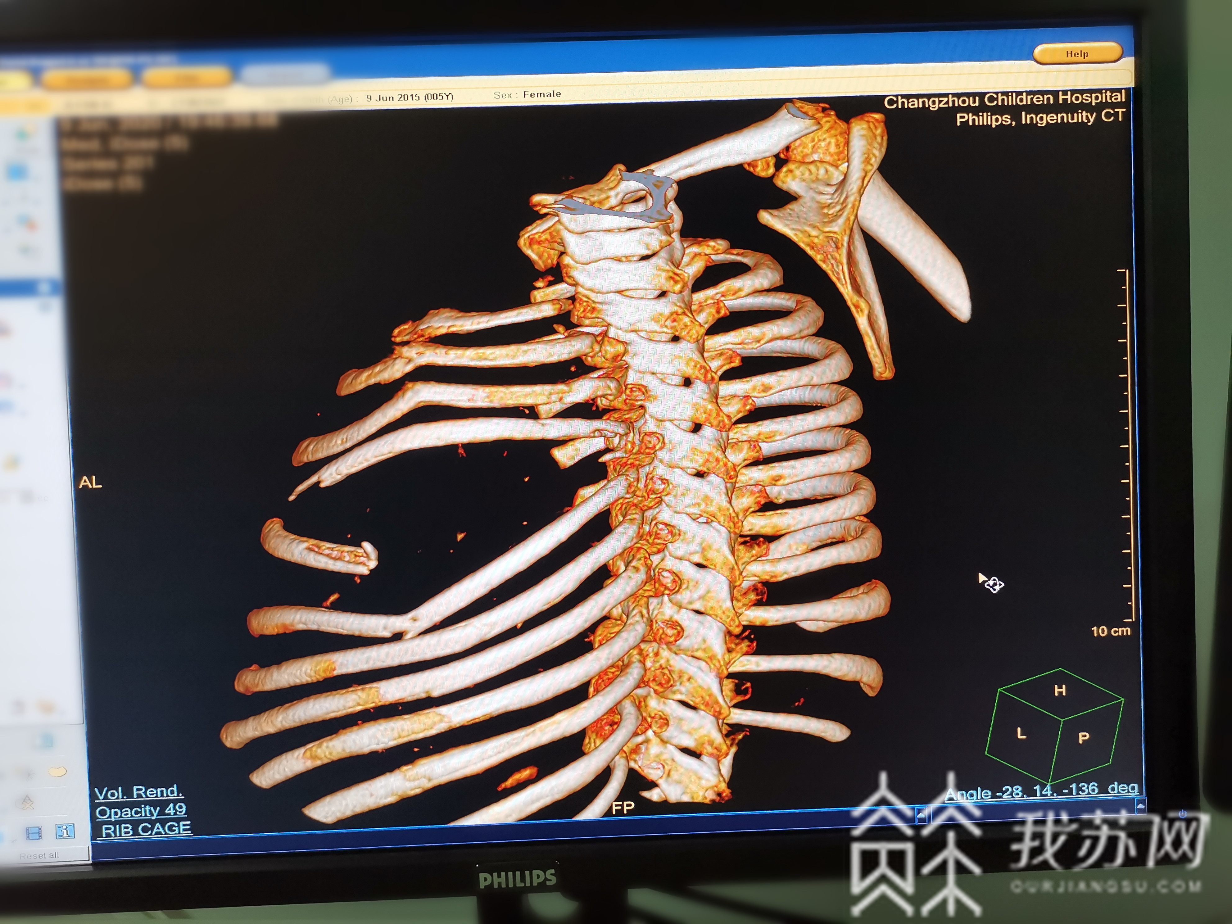 儿童医院■玻璃穿胸！常州3岁女童误开电瓶车撞向玻璃门！儿童医院多学科联合抢救！
