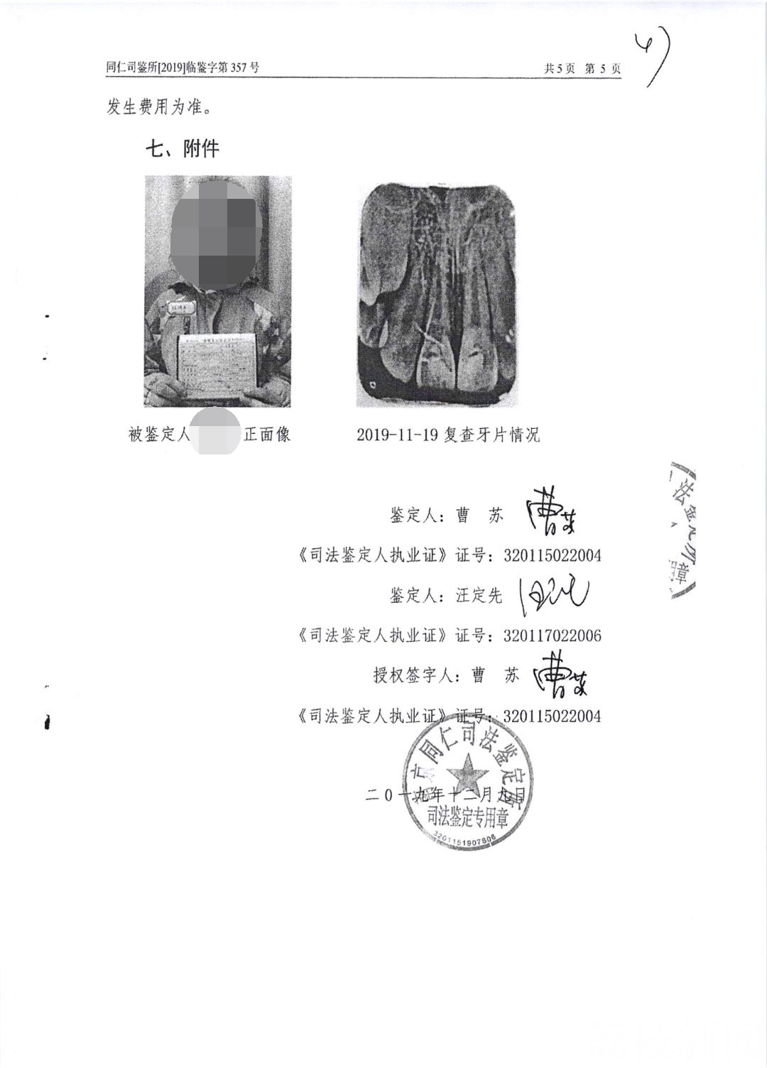 『门牙』 10年后的种牙费现在就得给！ 伸腿使绊致同学磕断两颗门牙