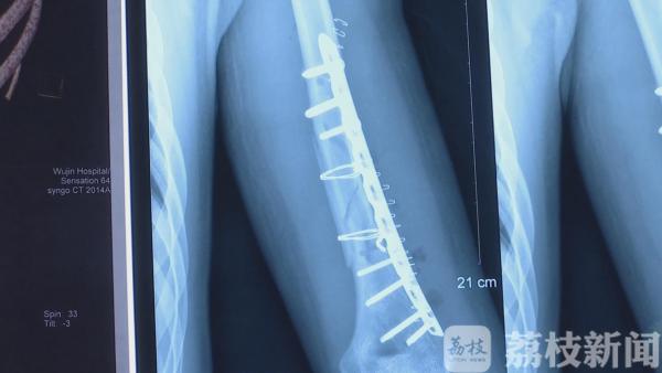 两小伙掰手腕不料掰出意外 “咔嚓”一声手臂断了