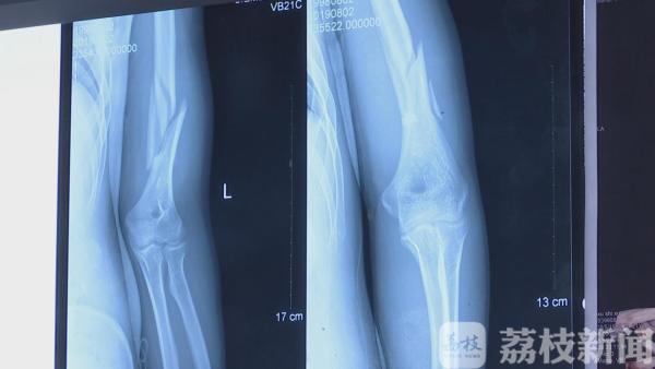 两小伙掰手腕不料掰出意外 “咔嚓”一声手臂断了