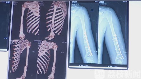 两小伙掰手腕不料掰出意外 “咔嚓”一声手臂断了