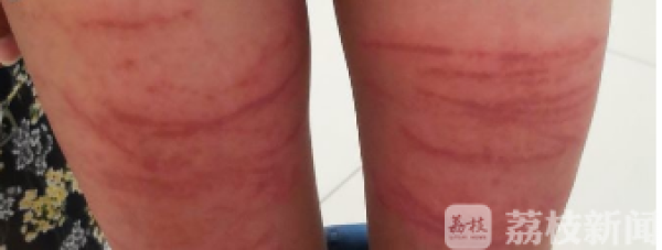 一小伙海边游泳 竟被这东西送进医院！