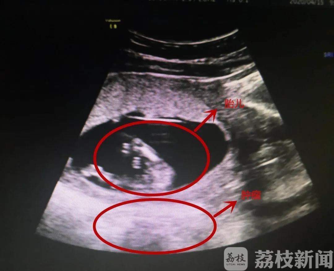 ■真要命！胎儿旁边竟是10厘米肿瘤，医生果断这样操作……