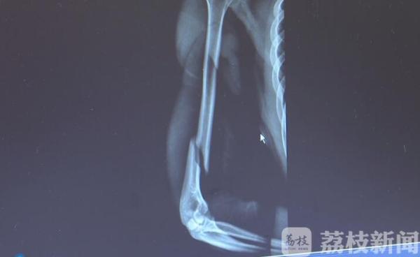 咔嚓！小伙扳手腕居然扳断了臂骨