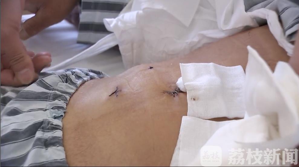 【手术】顺利完成两例肝癌手术 南通“达芬奇手术机器人”复工