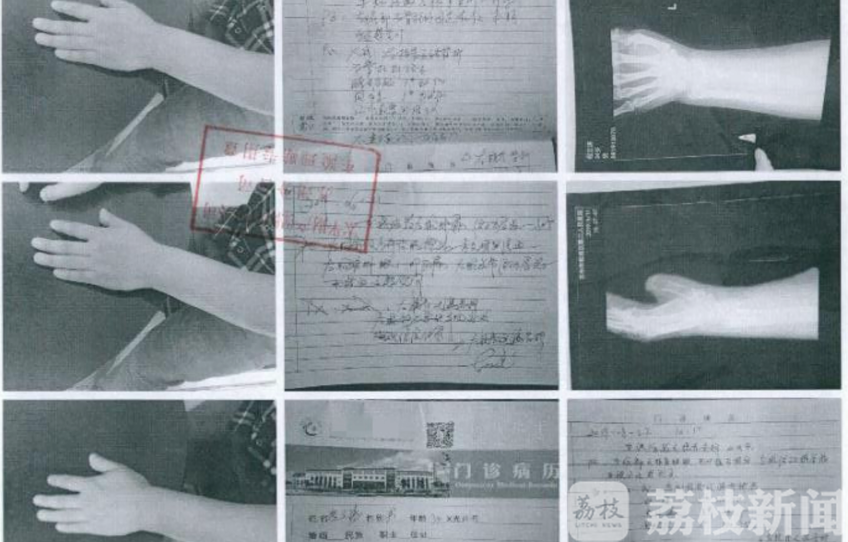 ■这个诈骗团伙不走心，骨折的都是同一部位……