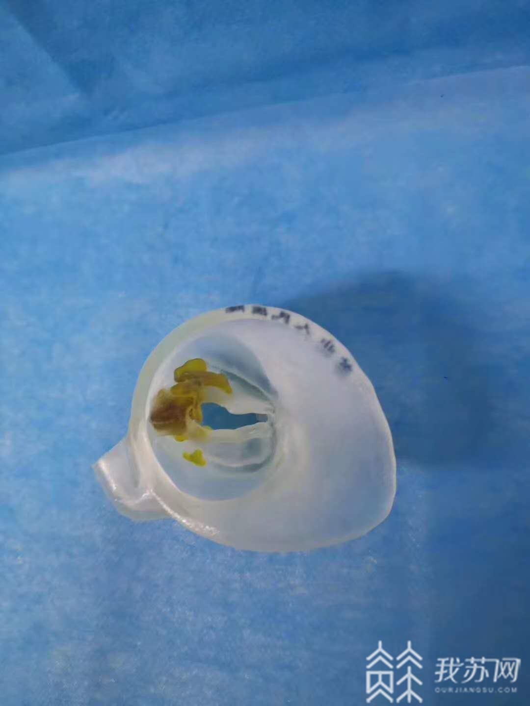 手术■3D打印辅助心脏手术，江苏第一例在扬州获得成功