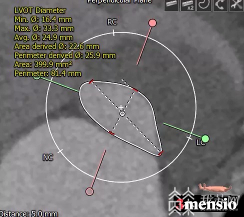 手术■3D打印辅助心脏手术，江苏第一例在扬州获得成功
