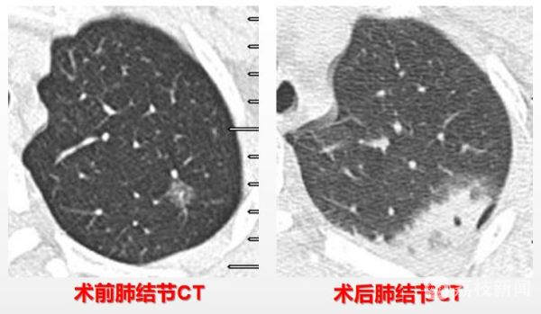 不开刀治肺结节 首例电磁导航引导肺结节微波消融术在