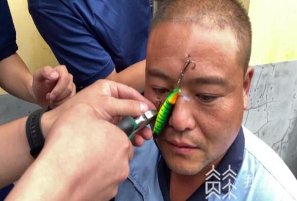 男子脸部多处被鱼钩钩住 其中一处距眼球不到一厘米