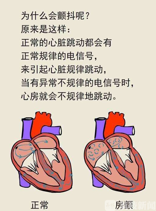 房颤的原因图片