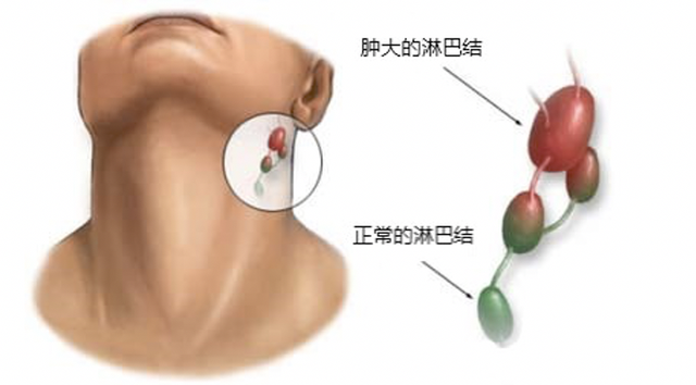 什么是淋巴瘤图片